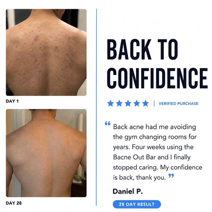 BODY ACNE BAR